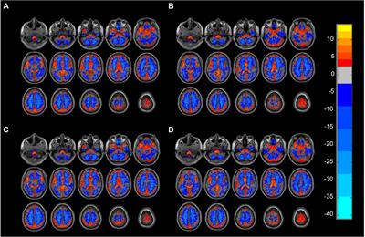 Olfactory functional covariance connectivity in Parkinson’s disease: Evidence from a Chinese population